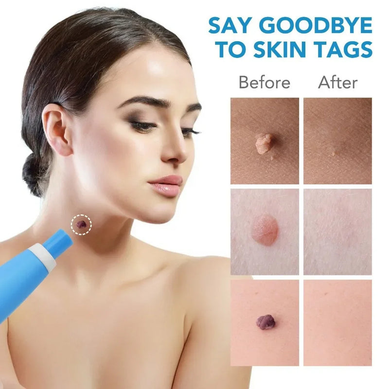 Painless Auto Skin Tag  Mole Removal Kit