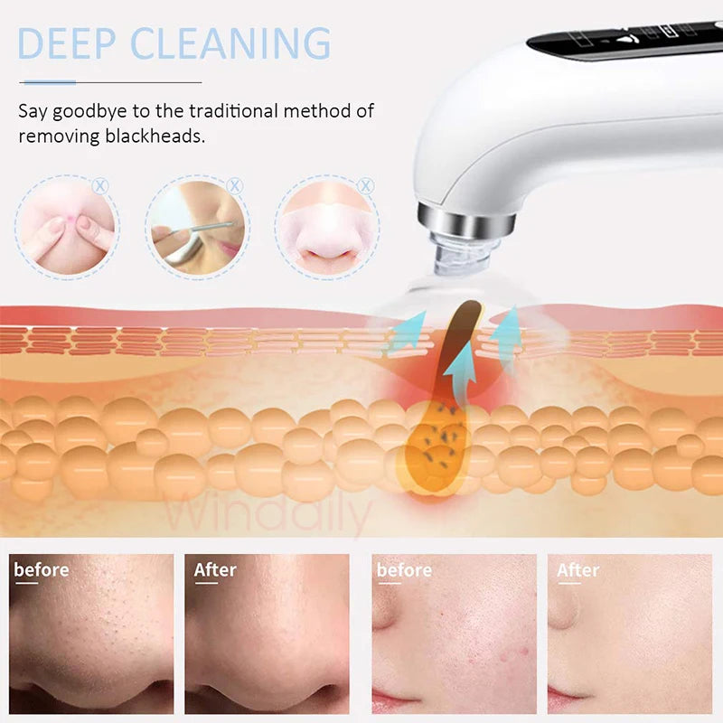 Blackhead Remover Pore Vacuum Cleaner